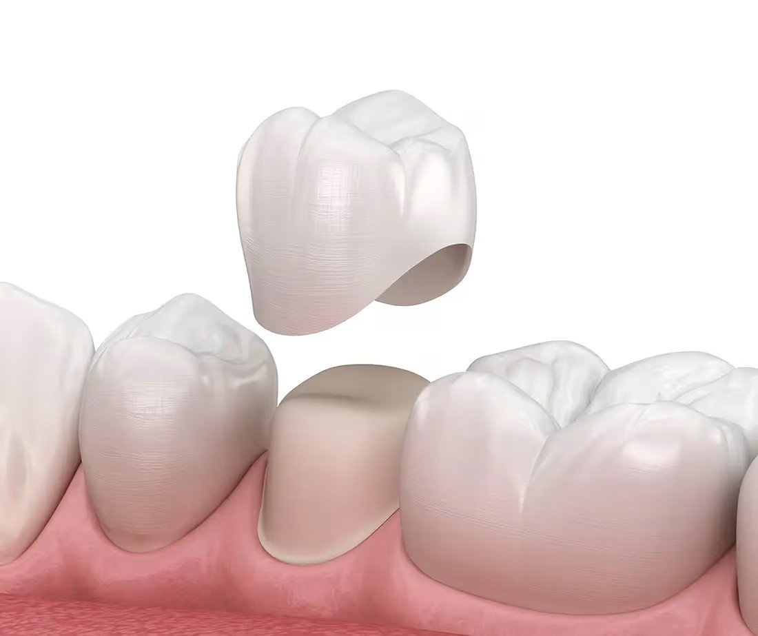 dental crown